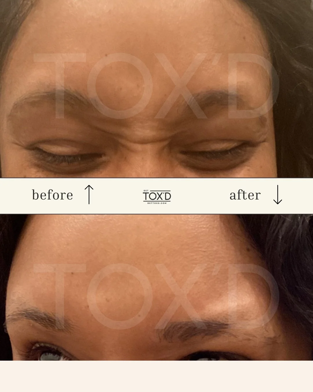 Botox real results crow’s feet transformation at Tox’d
