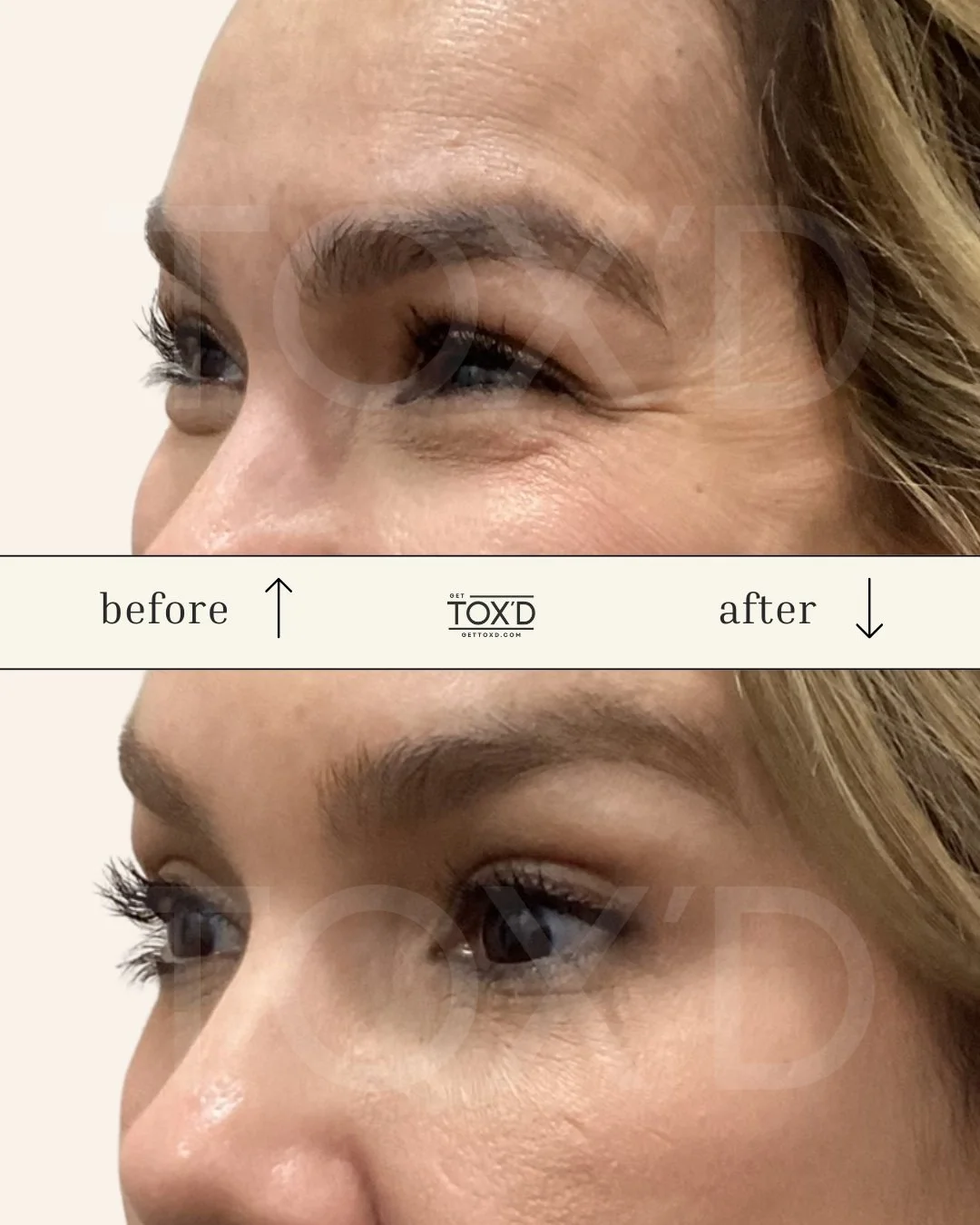 Botox results for crow’s feet wrinkles—real results client at Tox’d Medical Spa