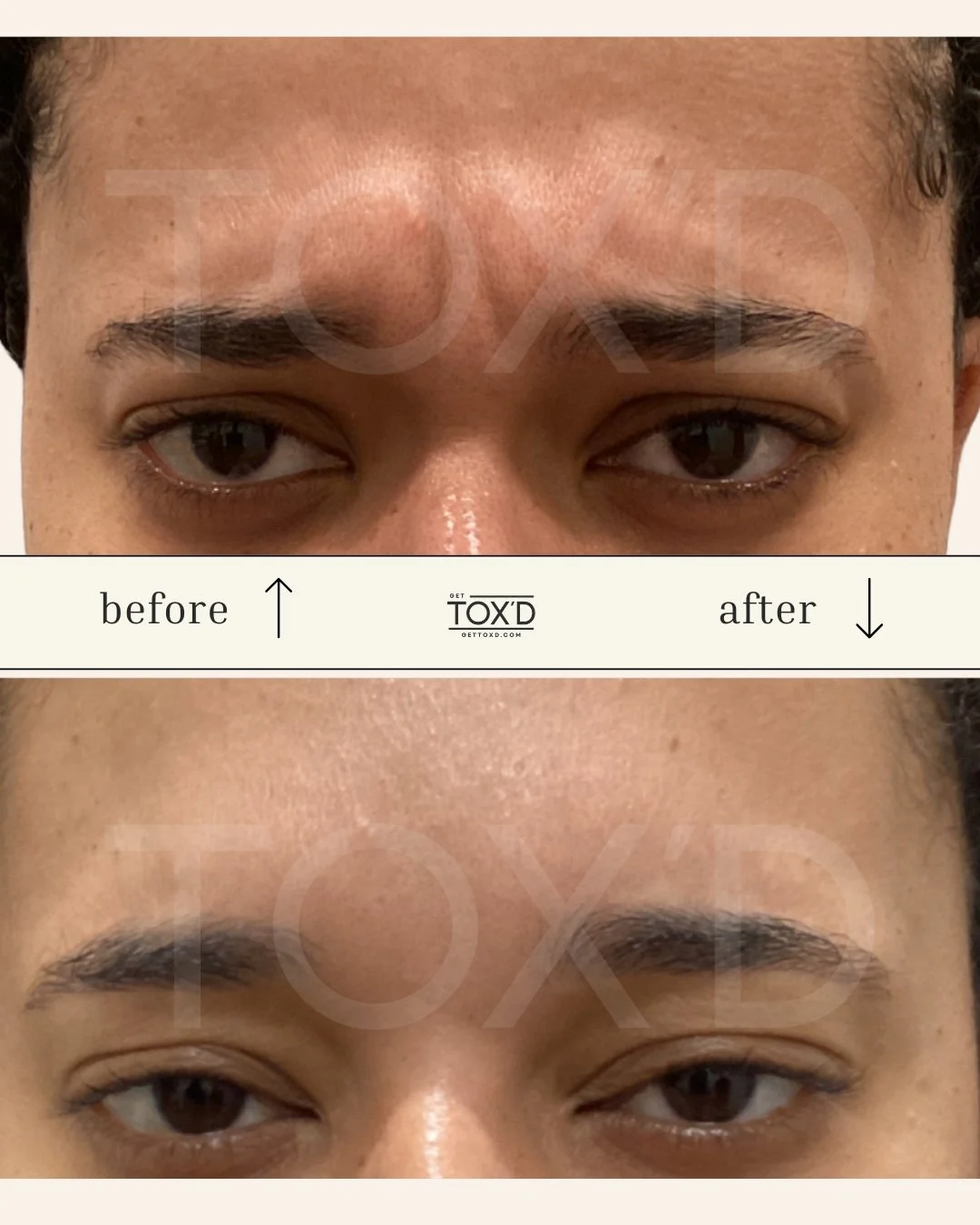 Natural botox results for crow’s feet—before and after at Tox’d