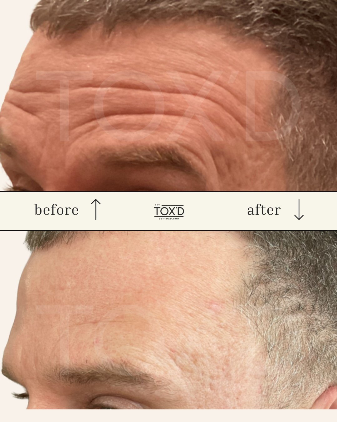 Botox results for forehead lines—real client at Tox’d Medical Spa