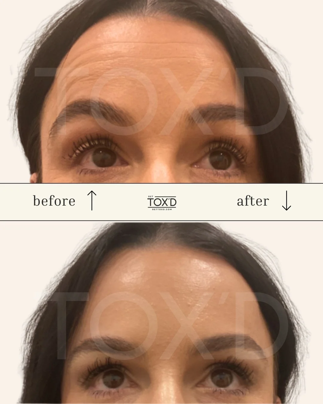 Botox real results on forehead lines, Tox’d Med Spa client