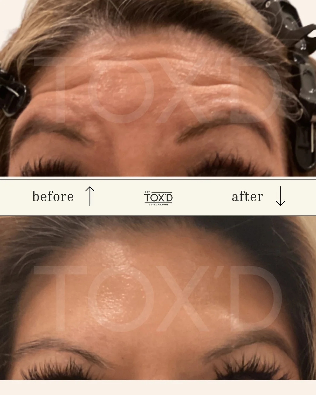 Botox real results: forehead before and after at Tox’d