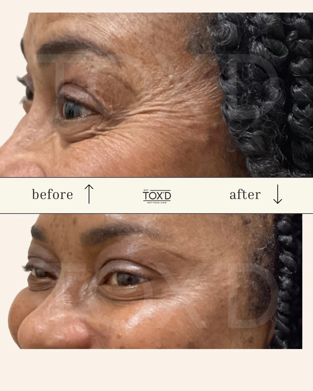 Natural botox results for crow’s feet—before and after at Get Tox’d
