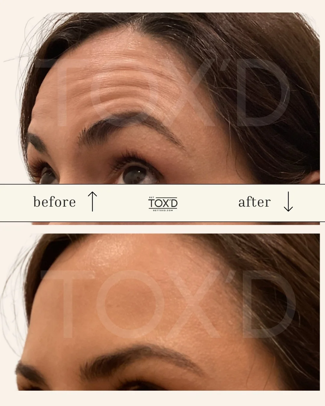 Forehead botox results, before and after photos from Tox’d