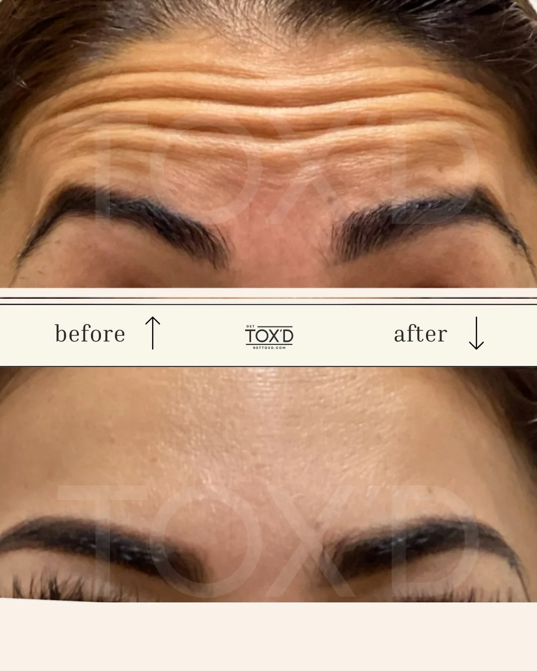 Real results of botox for forehead lines at Tox’d