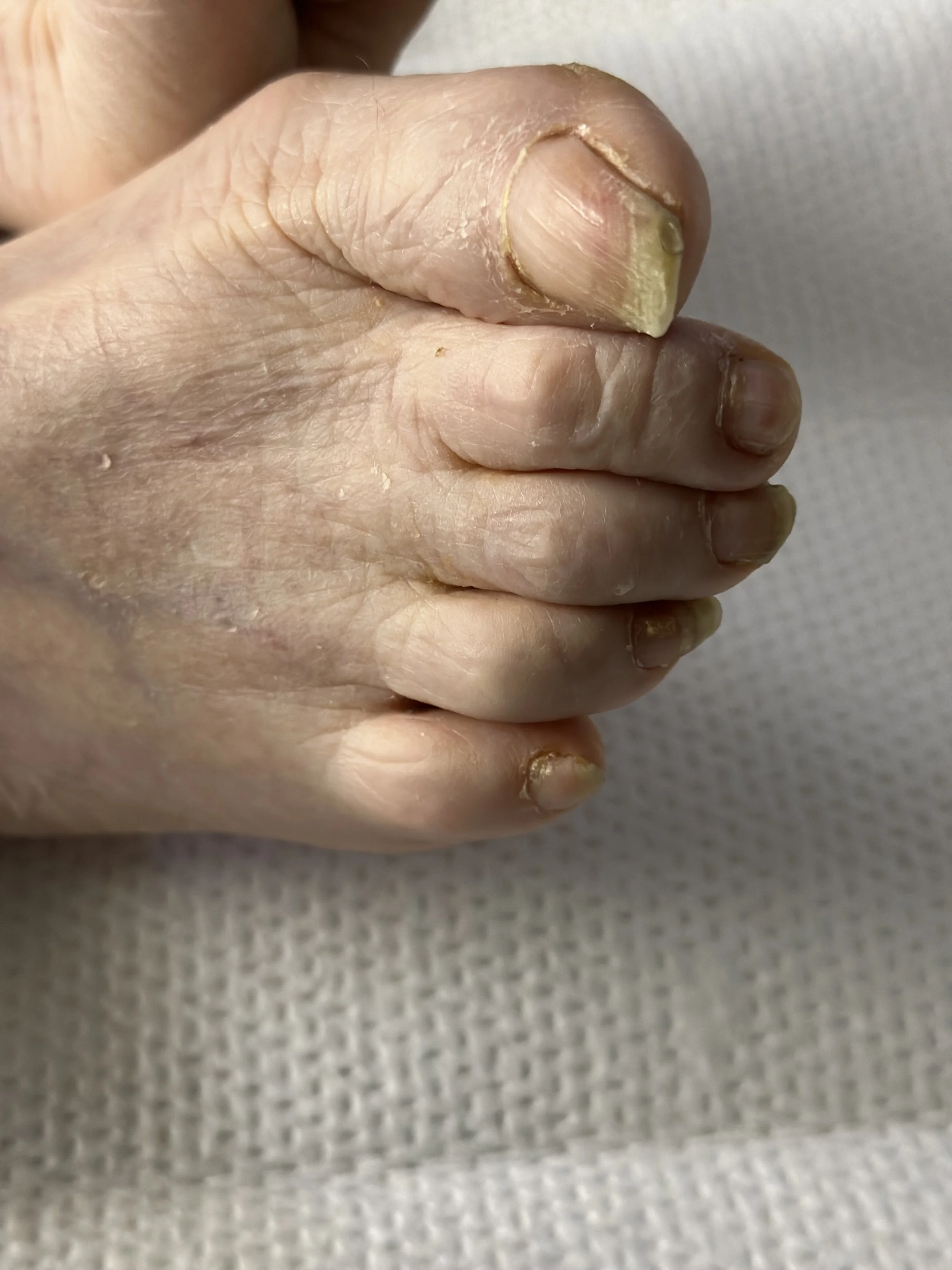 Close-up of a foot with cracked toenails and dry skin on a textured fabric surface.
