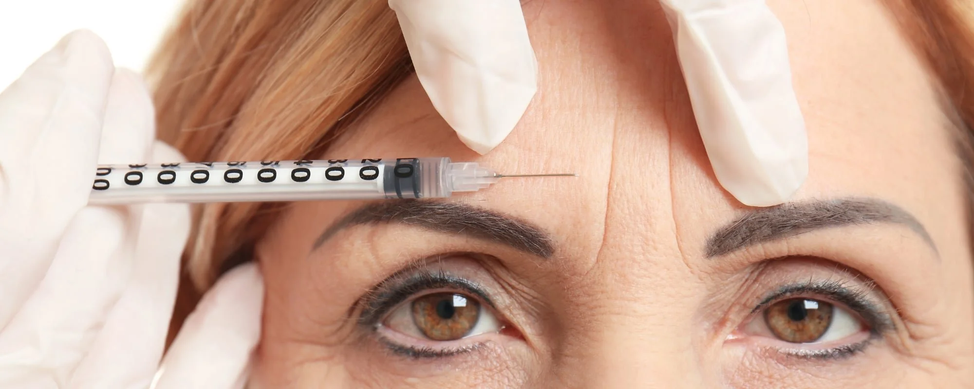 A woman receiving an Botox injection in her forehead using a syringe, with medical gloves on her face.