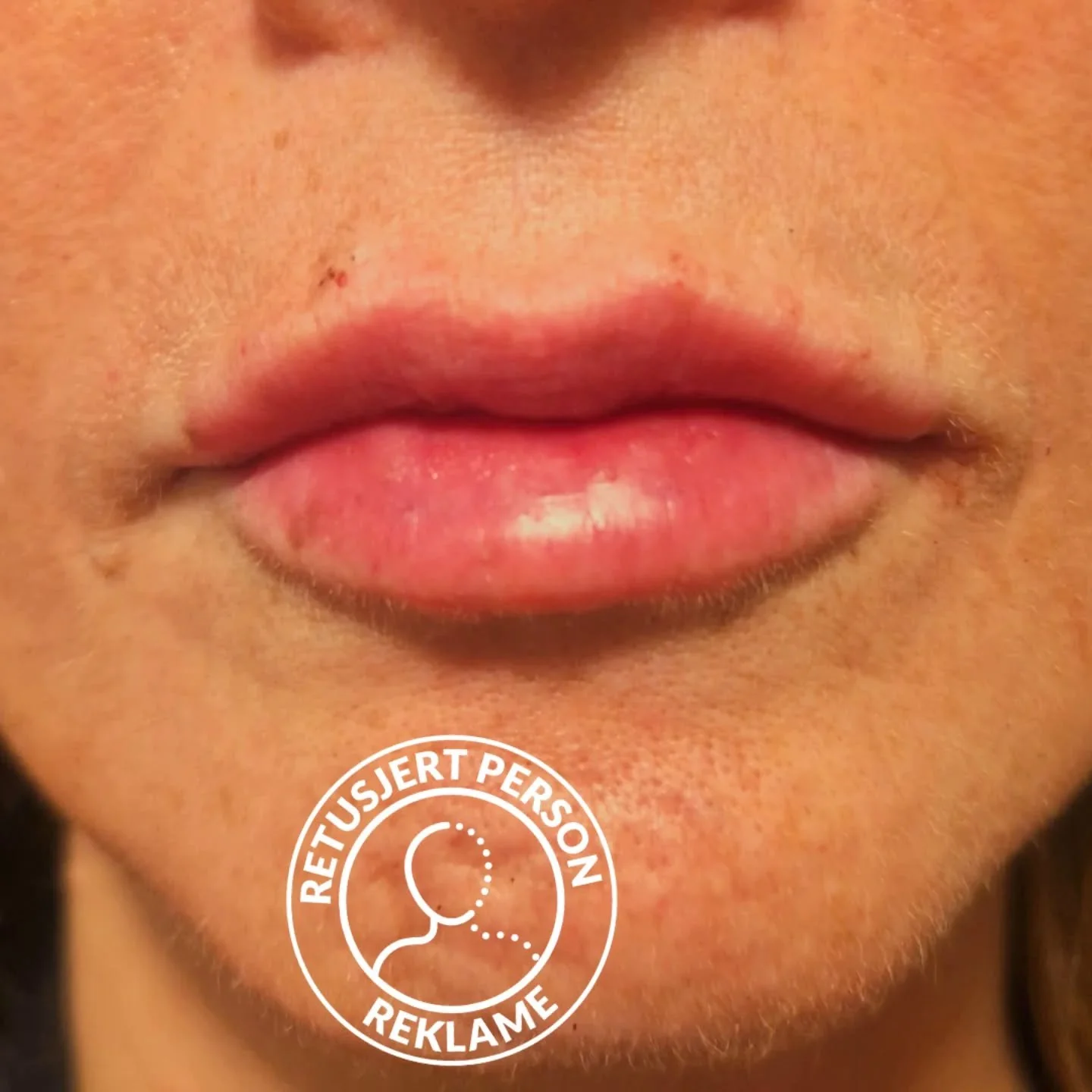 Her er det brukt 1ml filler fordelt i over-og underleppe. Bildet er tatt rett etter behandlingen 💉

Vi har 18-&aring;rs aldersgrense, og behandlingen er ikke for gravide eller ammende. Vi behandler ogs&aring; mange menn som &oslash;nsker filler-beha