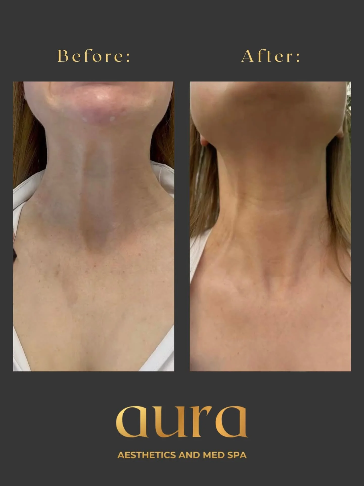 This is what a Nefertiti lift actually looks like✨

No surgery. No downtime. Just a few units of neurotoxin strategically placed along the lower jaw and neck bands, and your neck looks longer, smoother, and more lifted.

It&rsquo;s subtle. That&rsquo