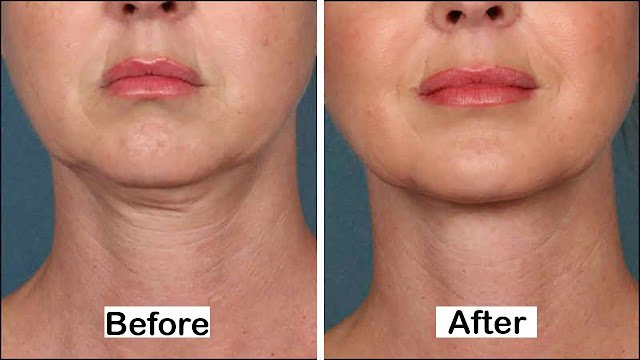RF Microneedling Neck