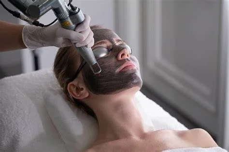Carbon Laser Facial