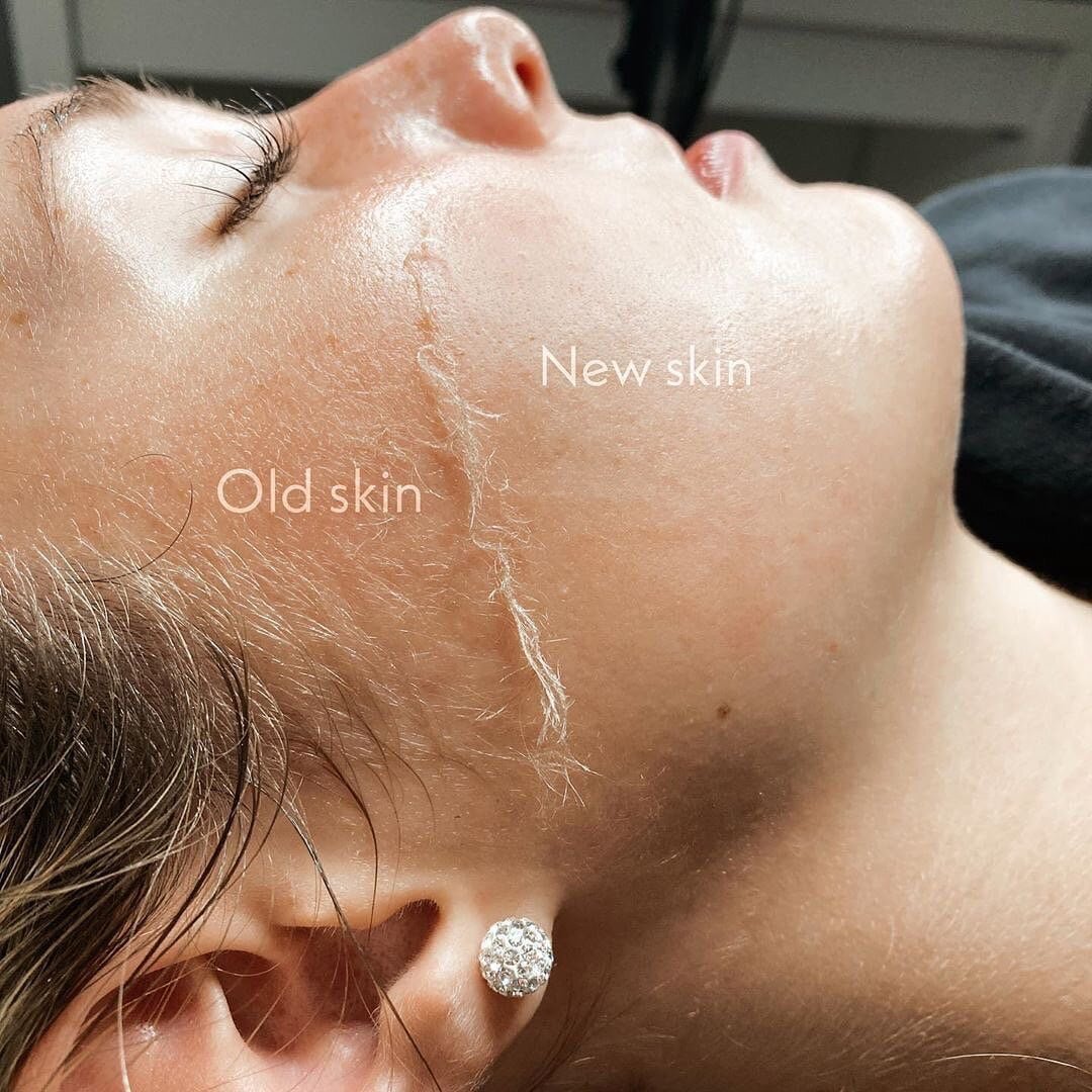 dermaplaning_1200x.jpg