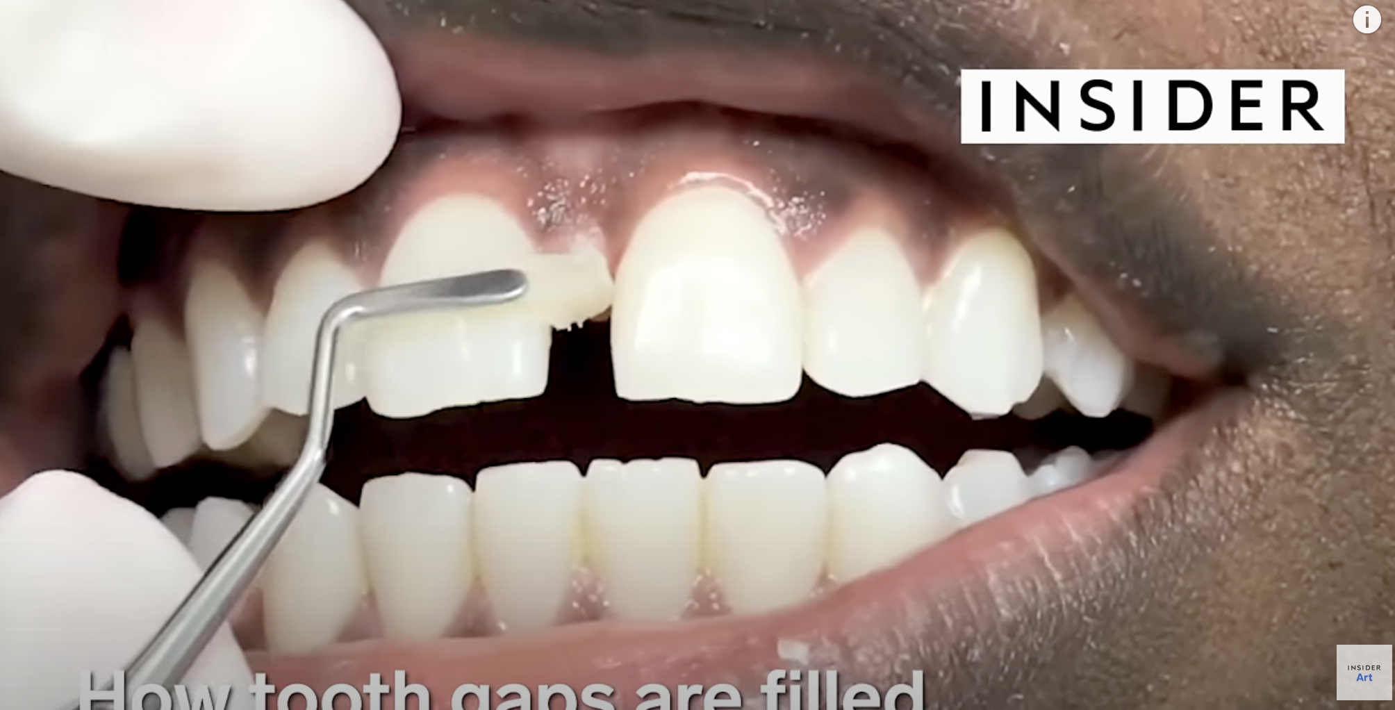 Insider Art - How Tooth Gaps Are Filled - 5.3M Views - Producer