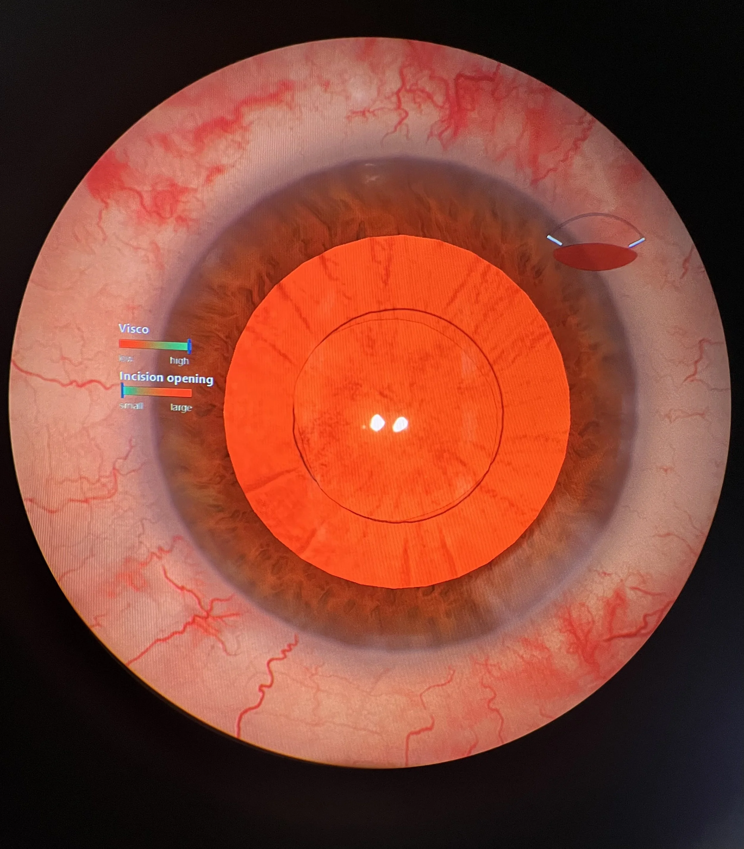 Using the Eyesi Cataract Simulator Before Ophthalmology Training: Is It Worth It?