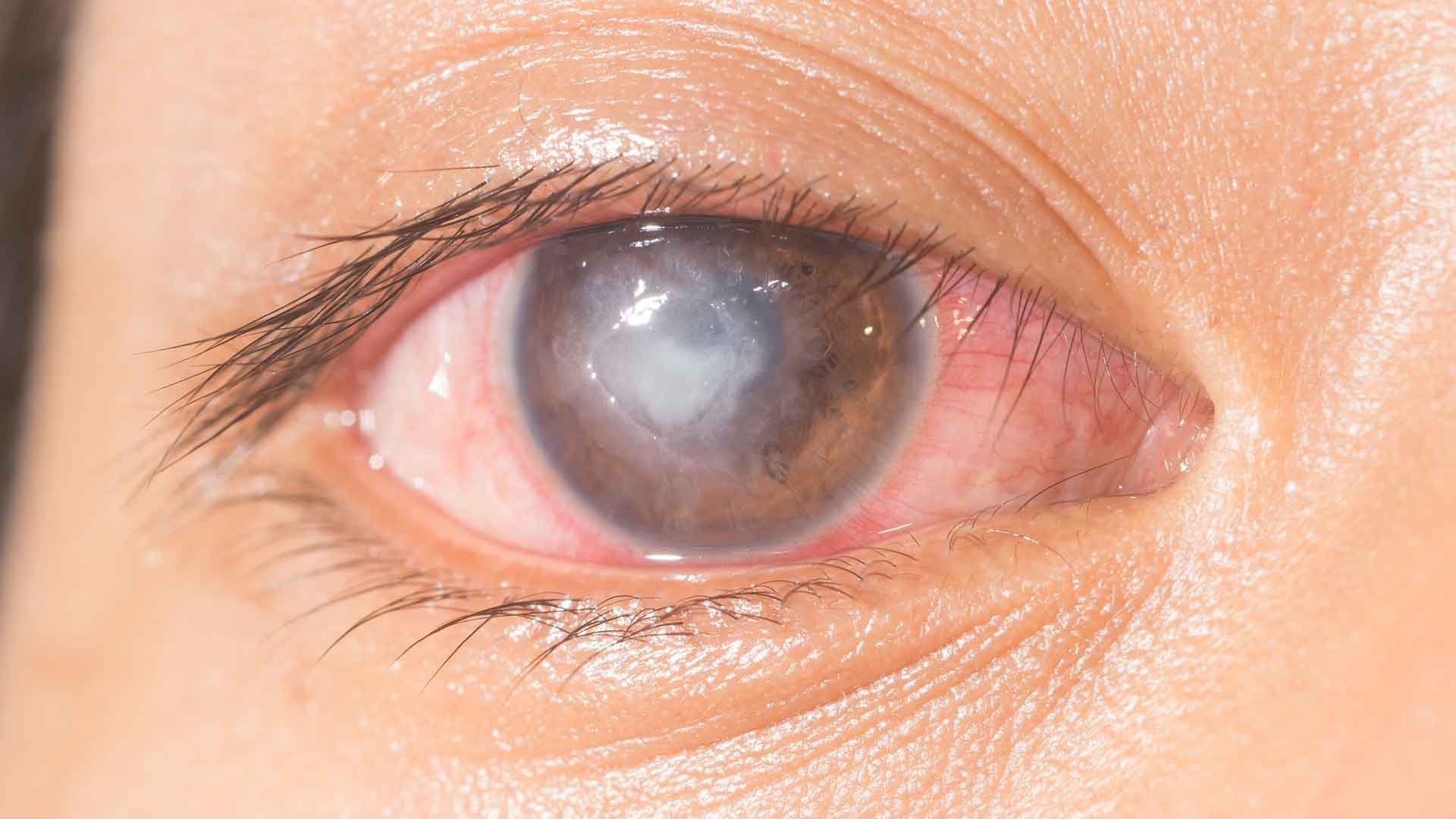 Microbial Keratitis: Resistance Patterns and Therapeutic Limitations in the Modern Era