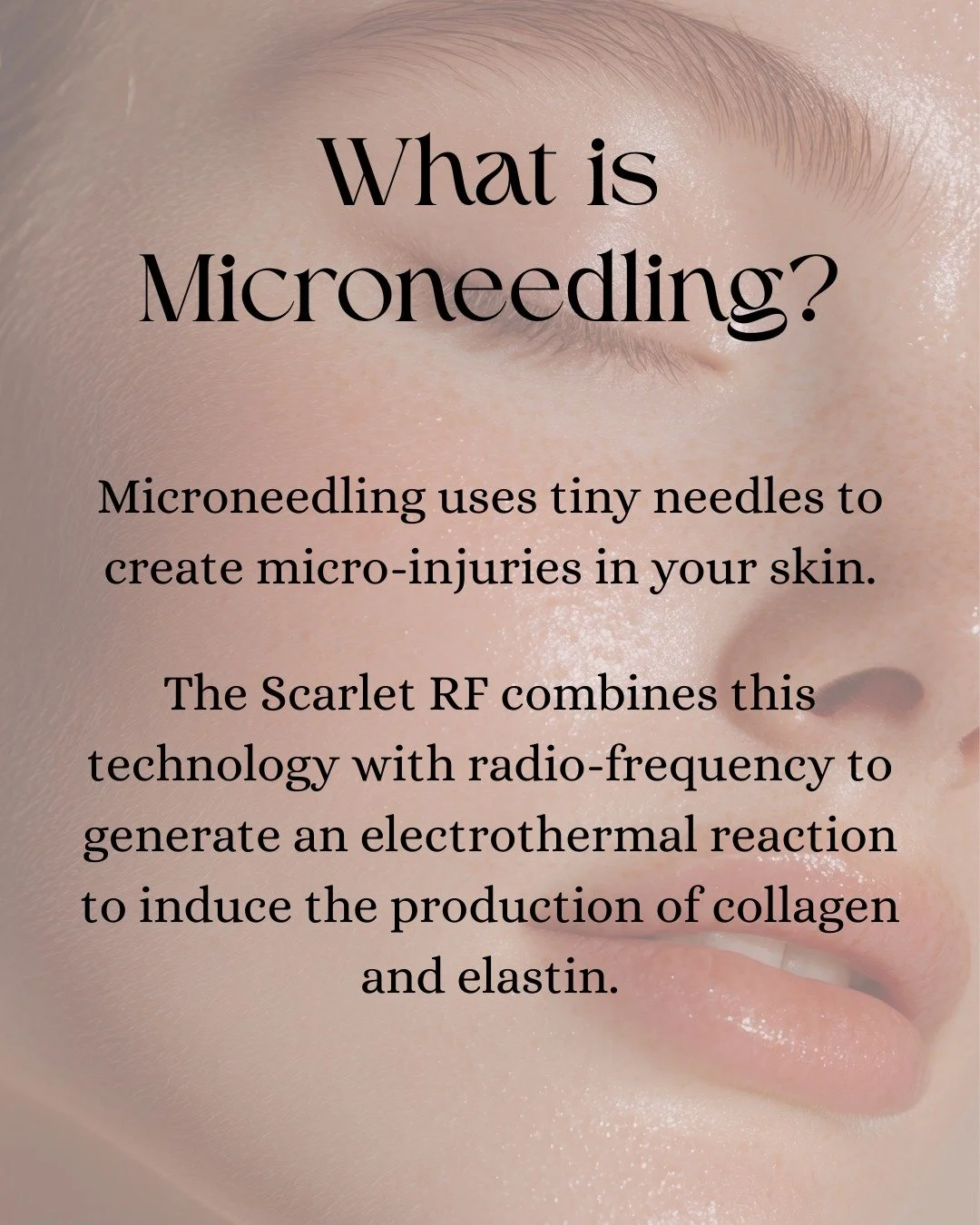 Why add radio-frequency to your microneedling?
Scarlet SRF distributes RF energy through an array of 25 non-insulated microneedles. As the RF signal passes through the skin, it generates an electrothermal reaction capable of coagulating the tissue at