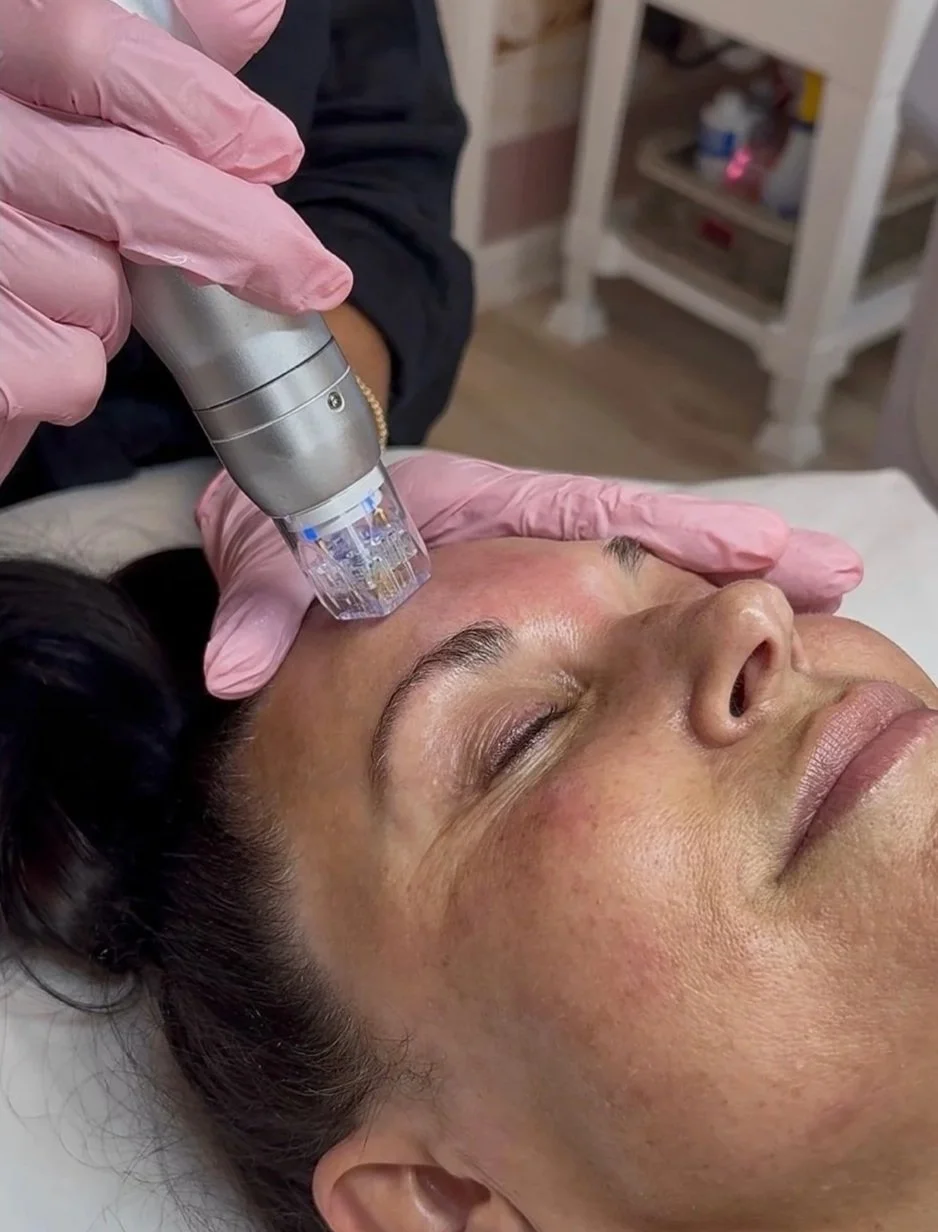 Radio Frequency Microneedling