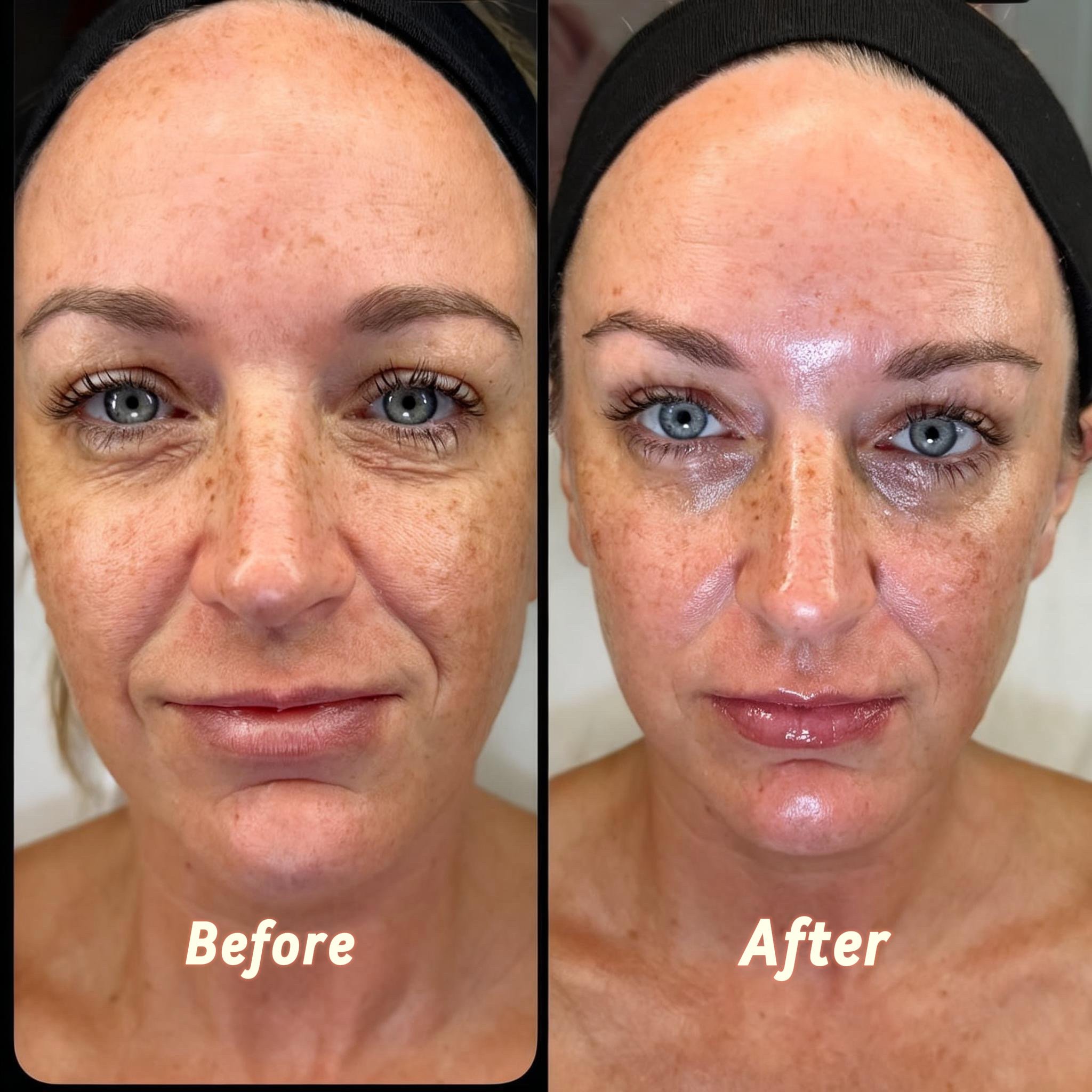 Collagen Building Blocks Treatment