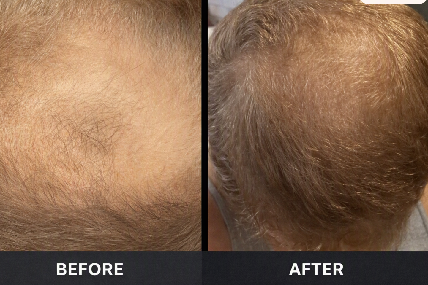Comparison of a person's scalp before and after hair restoration, showing increased hair density in the after image.