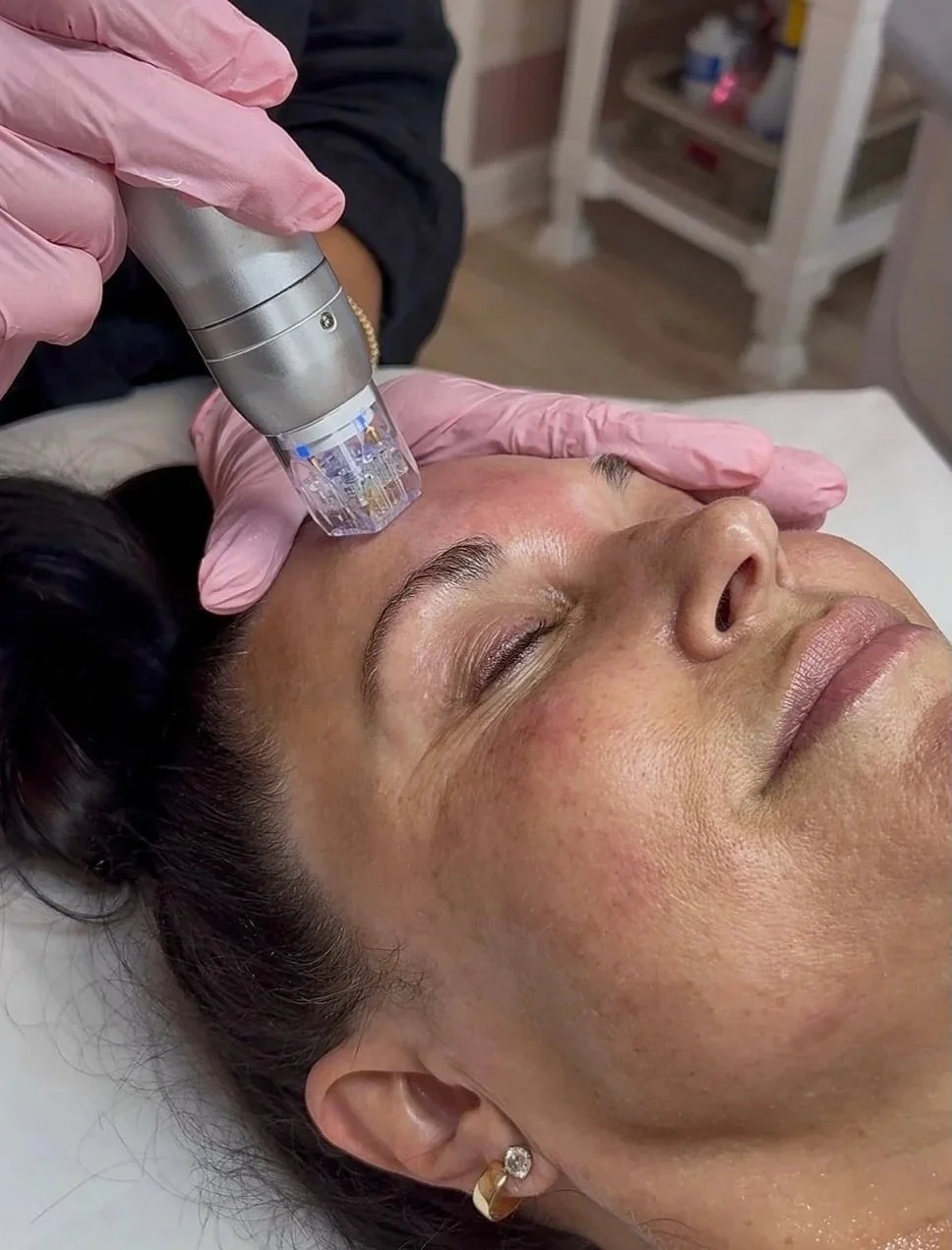 Microneedling Facial with Radiofrequency