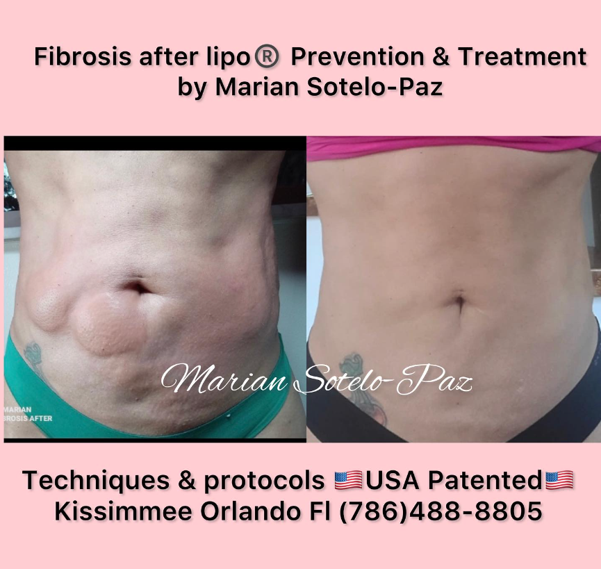 Before and after images showing fibrosis treatment results by Marian Sotelo-Paz, with contact information for techniques and protocols offered in Kissimmee, Orlando, FL.