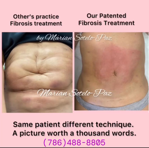 Comparison of fibrosis treatments on the abdomen, showing results from other practices versus a patented method, with visible skin texture differences. Includes contact information for further inquiries.