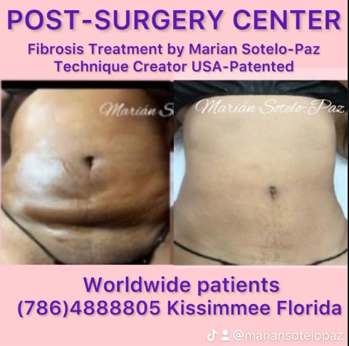 Before and after images of fibrosis treatment by Marian Sotelo-Paz, showcasing results on the abdomen. Includes contact information and notes technique is USA-patented. Location in Kissimmee, Florida.