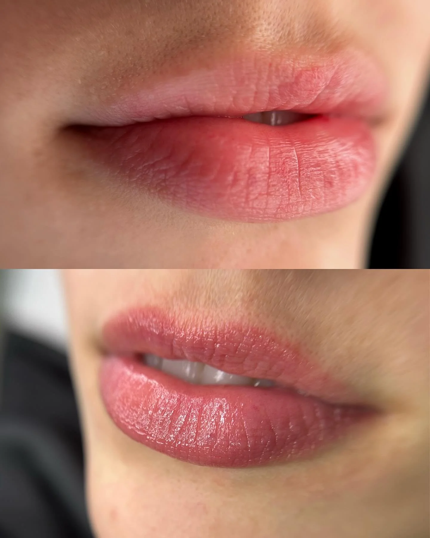 HEALED RESULTS✨

The most natural before and after.
For this case, the work was done to add more definition and contour, even out the color of the top and bottom lips, and still keep a soft, delicate rosy tone.

Plus everyday practicality with result