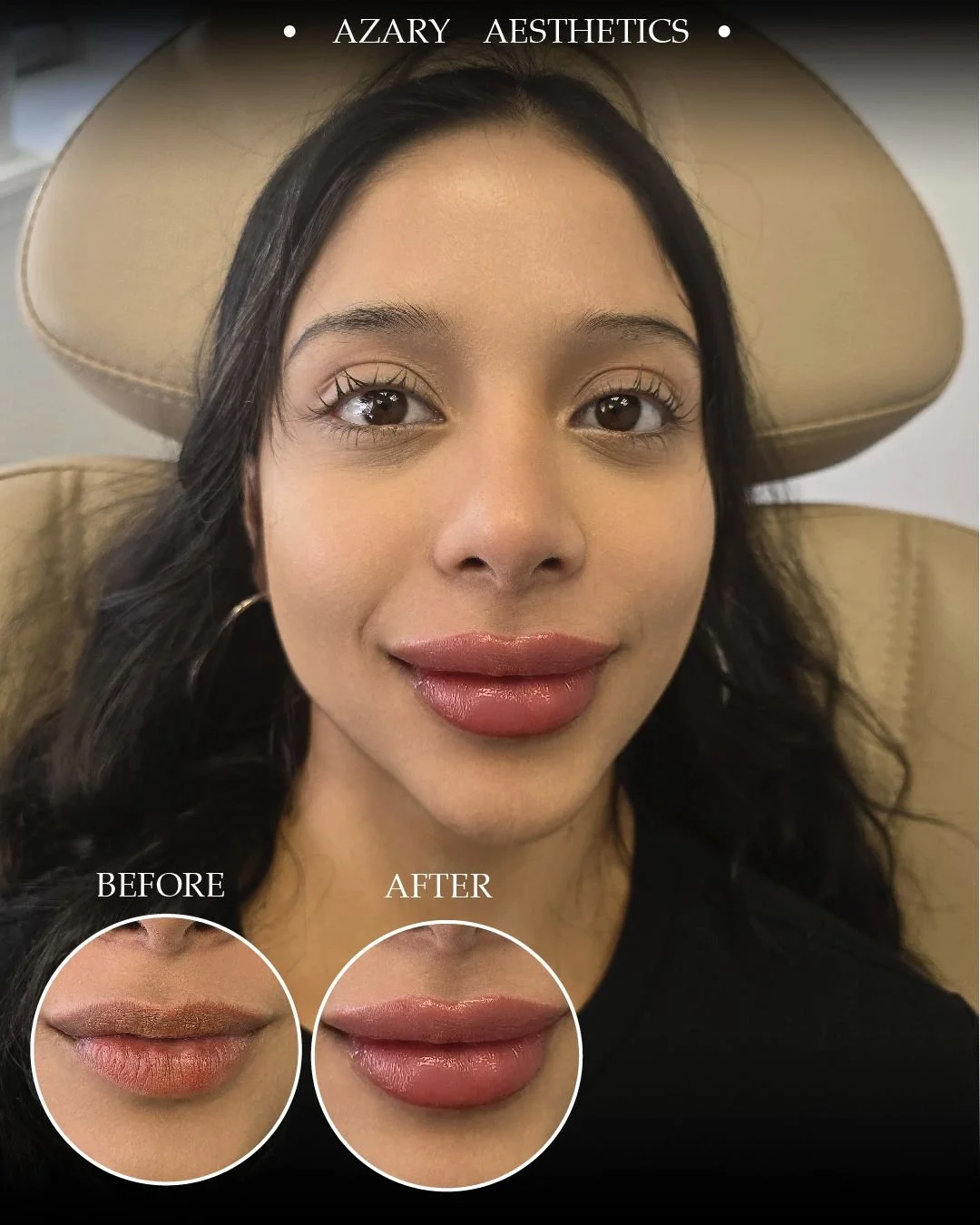 A woman sitting in a chair, showing a before and after comparison of her lips. She has long dark hair, light makeup, and is smiling slightly. The after photo shows her lips are fuller and more defined, with a shiny gloss. The setting appears to be a