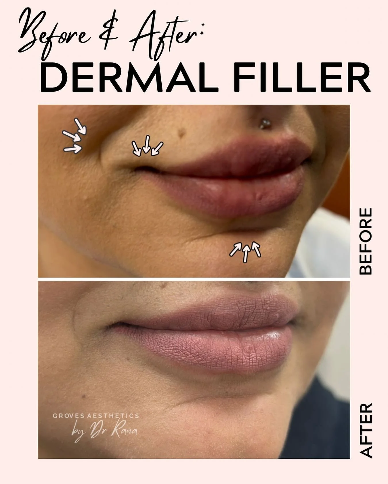✨ Before &amp; After: Strategic Dermal Filler ✨

Sometimes it&rsquo;s the small, subtle tweaks that make the biggest difference. 💫

Here, dermal filler was placed strategically to:
 ⬆️ Lift the corners of the mouth
 💧 Soften the deep chin crease un