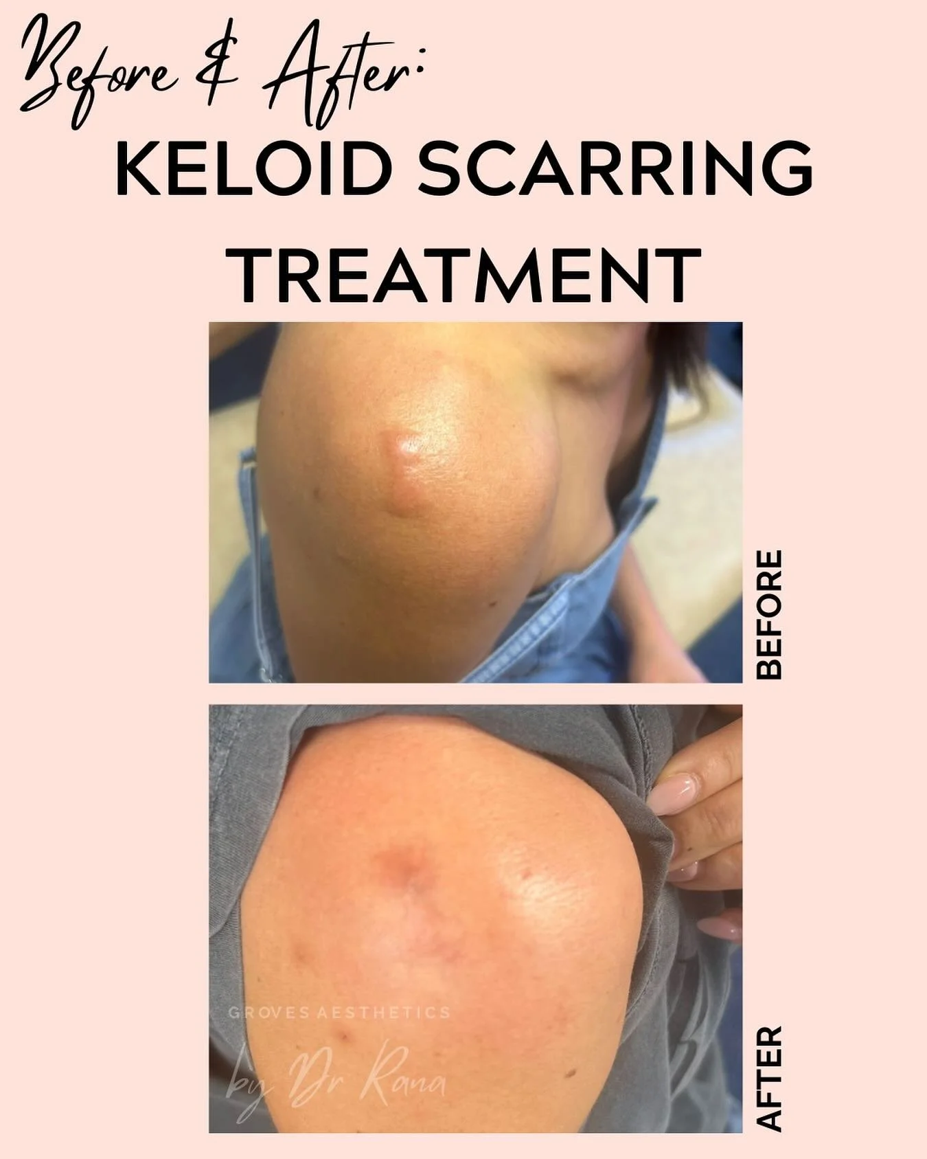 ✨ Keloid scar treatment in progress ✨⁣
⁣
The photo above shows results after just ONE session of steroid injections! 💉⁣
⁣
Steroid injections are a safe and effective way to flatten and soften raised keloid scars by reducing inflammation and excess c