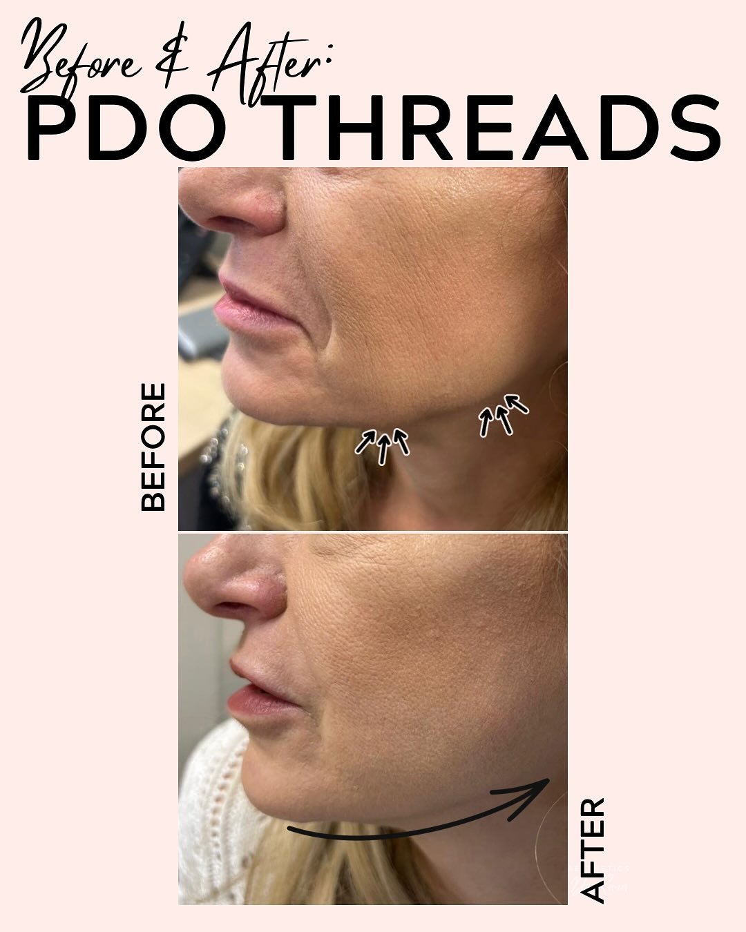 ✨ Look at the difference ✨

Notice the smoother, plumper skin, the softer lines, and a beautifully defined jawline. 💫

👉 How it works: PDO (polydioxanone) threads are placed beneath the skin to gently lift and tighten while stimulating collagen pro