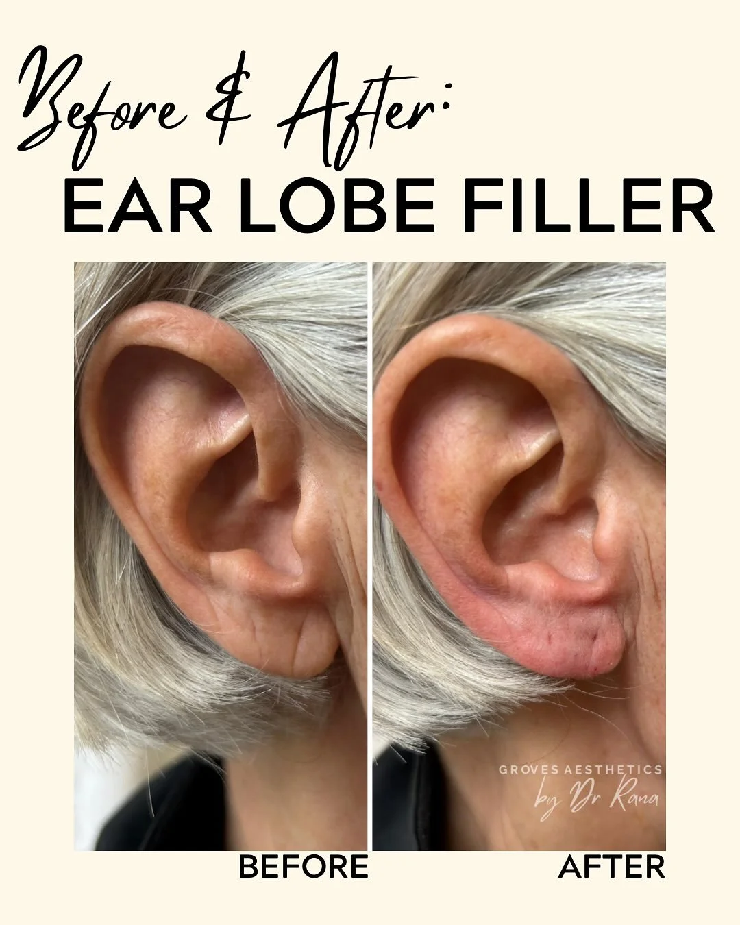 ✨ Subtle changes, big confidence boost. ✨

Ear lobe filler restores volume and smooths the appearance of stretched or thinned lobes &mdash; because little details make a big difference.

#filler #dermalfiller #earlobefiller #skinboosters #aesthetic #