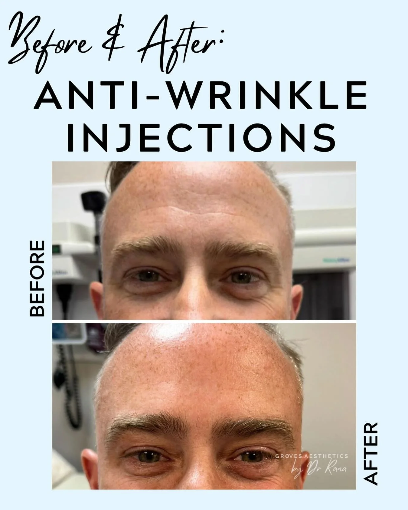 Targeted forehead anti-wrinkle treatment &mdash; smoothing lines for a refreshed, natural appearance while maintaining expression and character. 

Subtle, effective, and expertly delivered. 💉✨ 

#MensAesthetics #AntiWrinkle #NaturalResults #botox #s