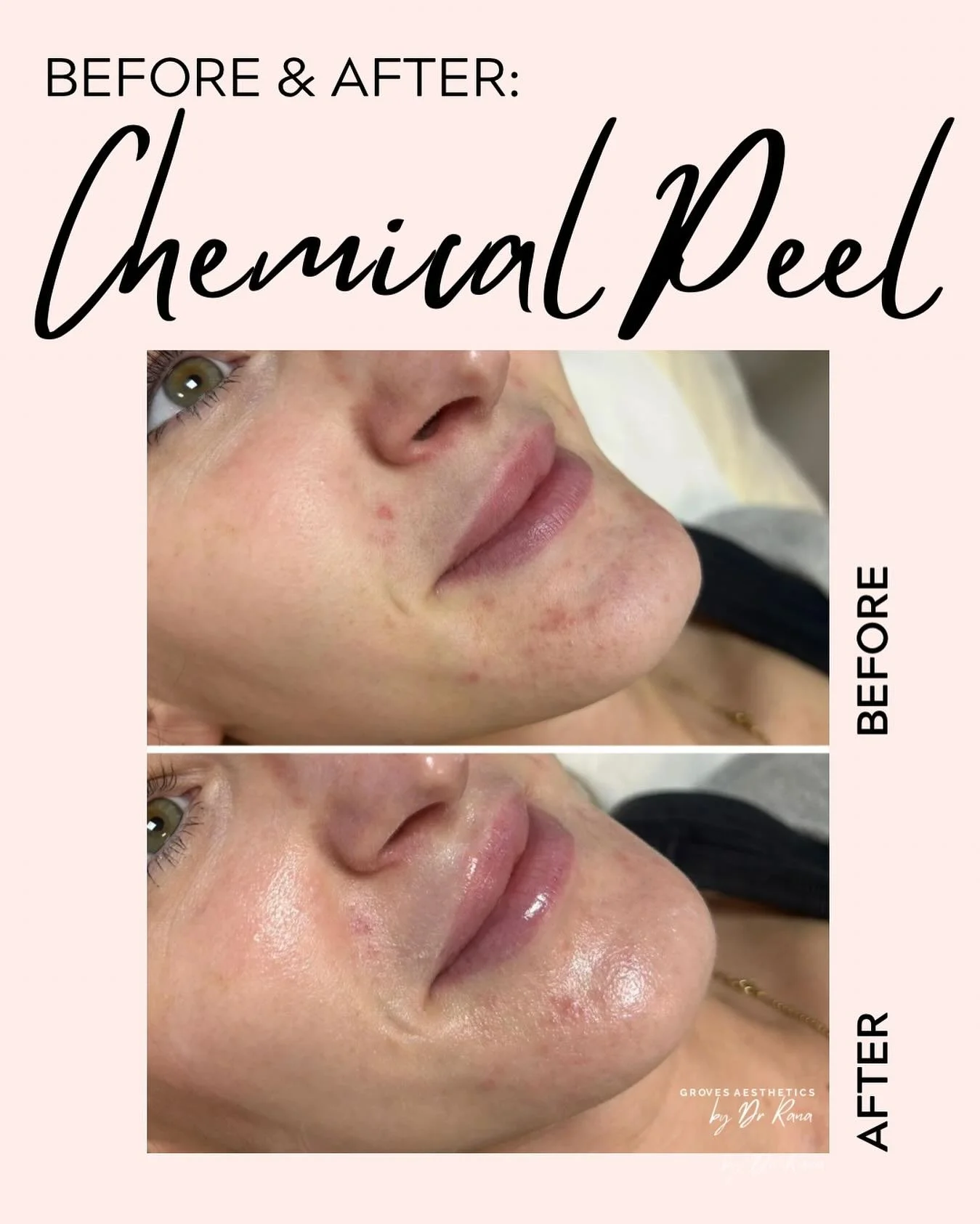 Real skin. Real results. 🌿

This glow came from a gentle yet powerful acne chemical peel &mdash; reducing breakouts and improving skin tone safely under Dr Rana&rsquo;s expert care. ✨

📍 Groves Aesthetics
📲 DM, email or call to make an appointment