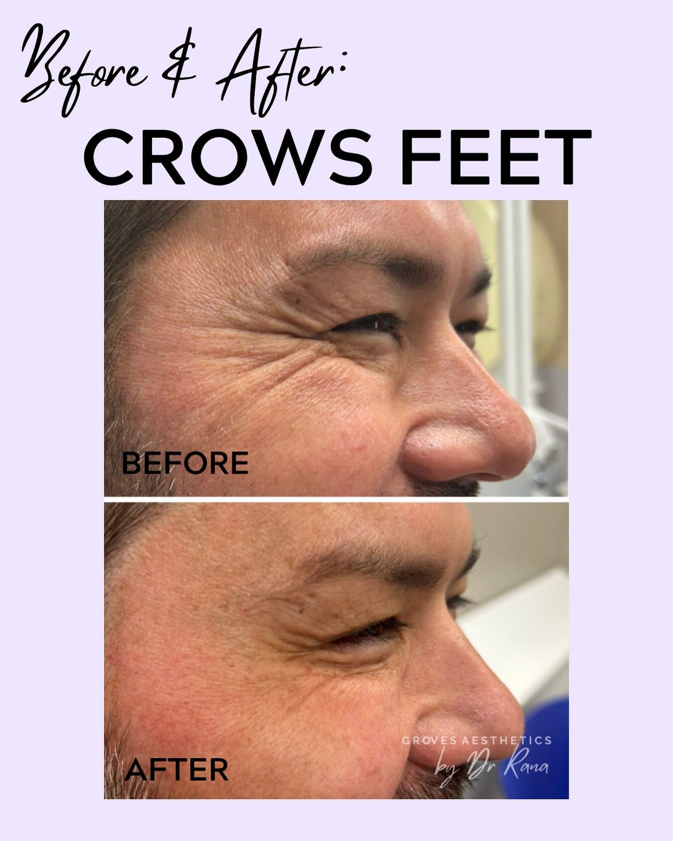 ✨ Subtle. Smooth. Refreshed. ✨

 A natural result after anti-wrinkle treatment for male crow&rsquo;s feet 👇
 Our goal is always realistic, rejuvenated results &mdash; never frozen.

💉 Performed by medical professionals
 📍 Groves Aesthetics
 📅 Boo