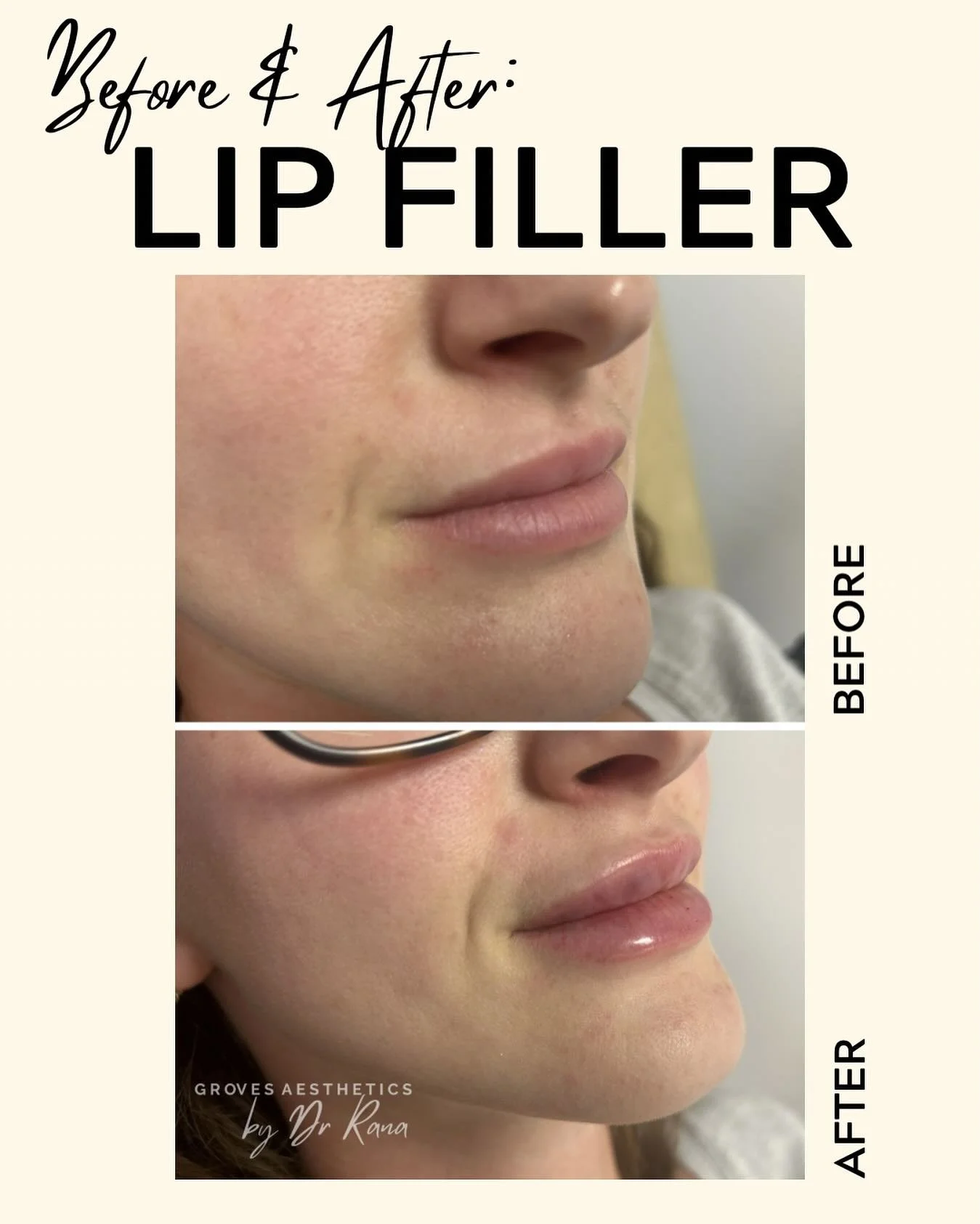 Before ➡️ After
Turn up the volume 💋

Full, confident lips &mdash; crafted by Dr Rana | Groves Aesthetics

#lipfiller #filler #dermalfiller #aesthetics #medicalaesthetician #drrana #grovesaesthetics #newmalden #horsley