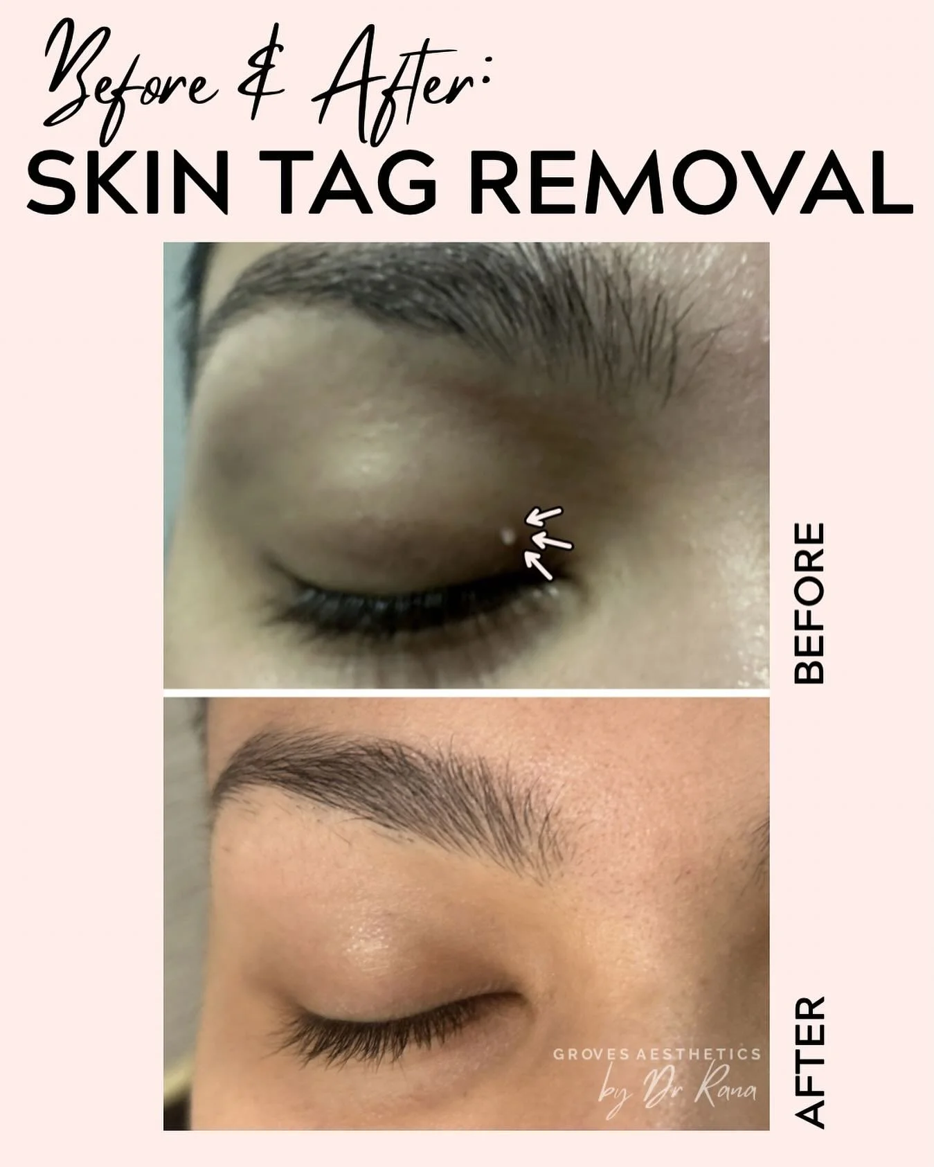 ✨ Aesthetics isn&rsquo;t always about injectables &mdash; it&rsquo;s about feeling comfortable and confident in your own skin. This patient had a small skin tag on the eyelid, safely removed and cauterised in clinic. 

Subtle treatments, meaningful r