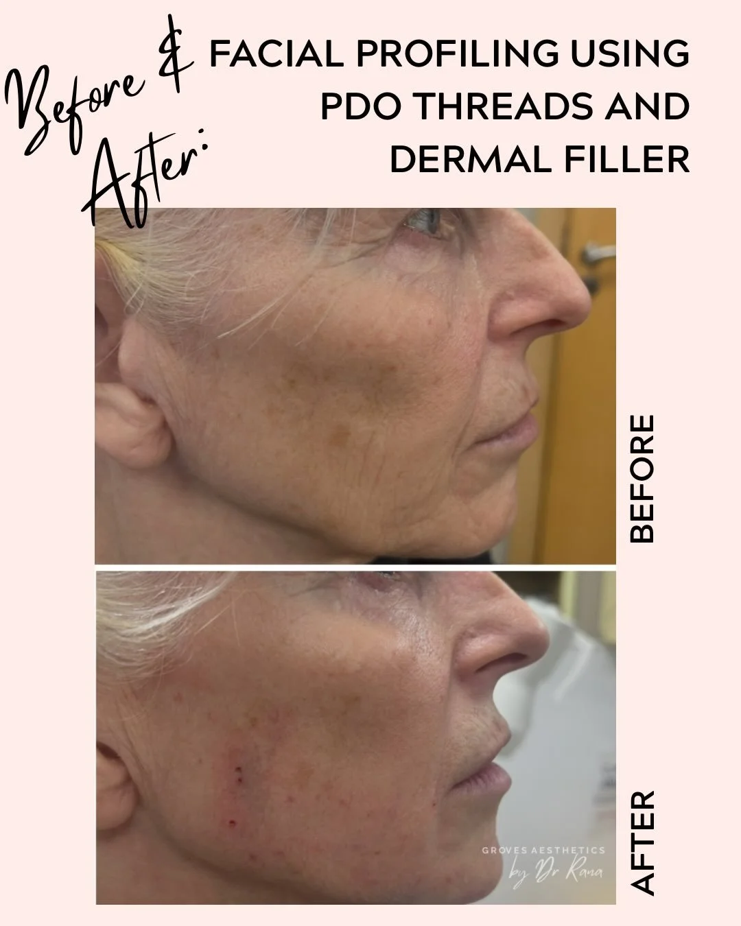 Beautifully enhanced facial profiling using a combination of PDO threads and dermal filler. ✨

This tailored treatment lifts, defines and restores natural contour &mdash; giving a refreshed, harmonious profile while maintaining a soft, natural look.
