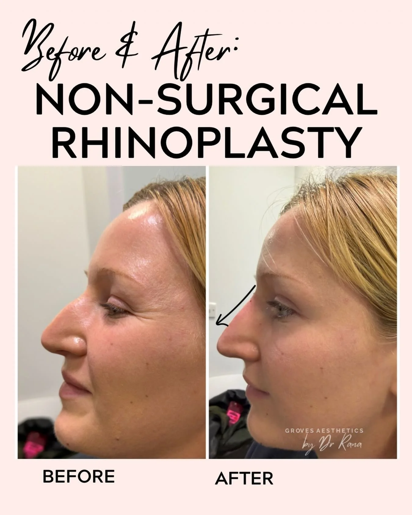 A small amount of dermal filler can make a big impact ✨ Subtle nose straightening for beautifully balanced results. 

#LiquidRhinoplasty #DrRana #ProfileBalancing #NoseFiller #NewMalden