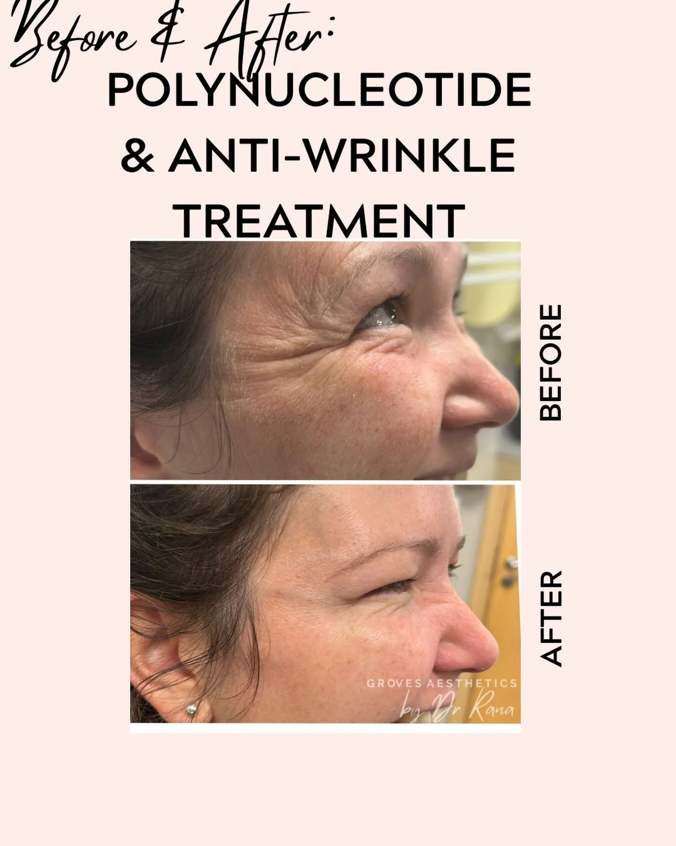 Fine lines around the eyes? 

The ultimate eye rejuvenation can be achieved used single or combined treatment methods

Polynucleotide- repair, hydrate, regenerate ✨

Anti- wrinkle injections to give smoother texture whilst keeping your expressions na