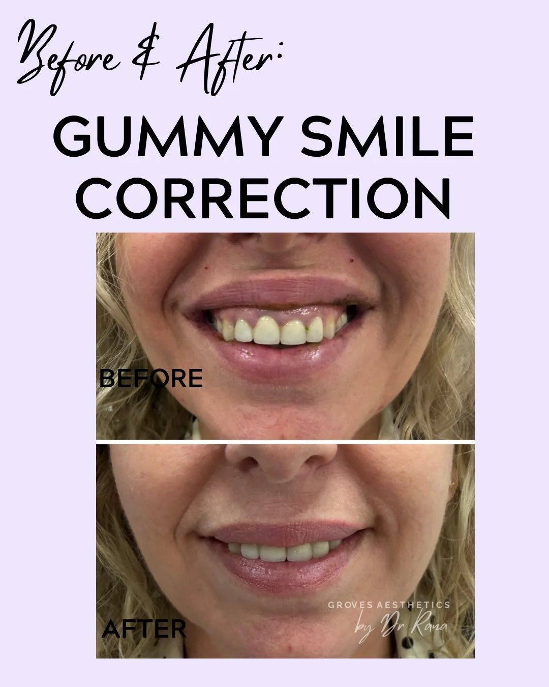 Came in this morning for review to see this perfect smile 💫

A small tweak for a big smile upgrade 

#DrRanaAesthetics #GummySmile #FacialAesthetics #Newmalden #horsley