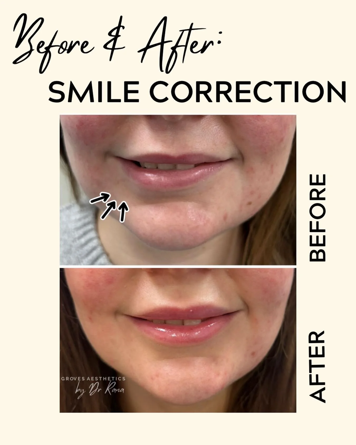 New smile, new confidence ✨ 

One side was working harder than the other, so using a small amount of muscle relaxing injection helped to restore symmetry. Finished with a light touch of dermal filler in the lips to softly enhance volume and boost hyd