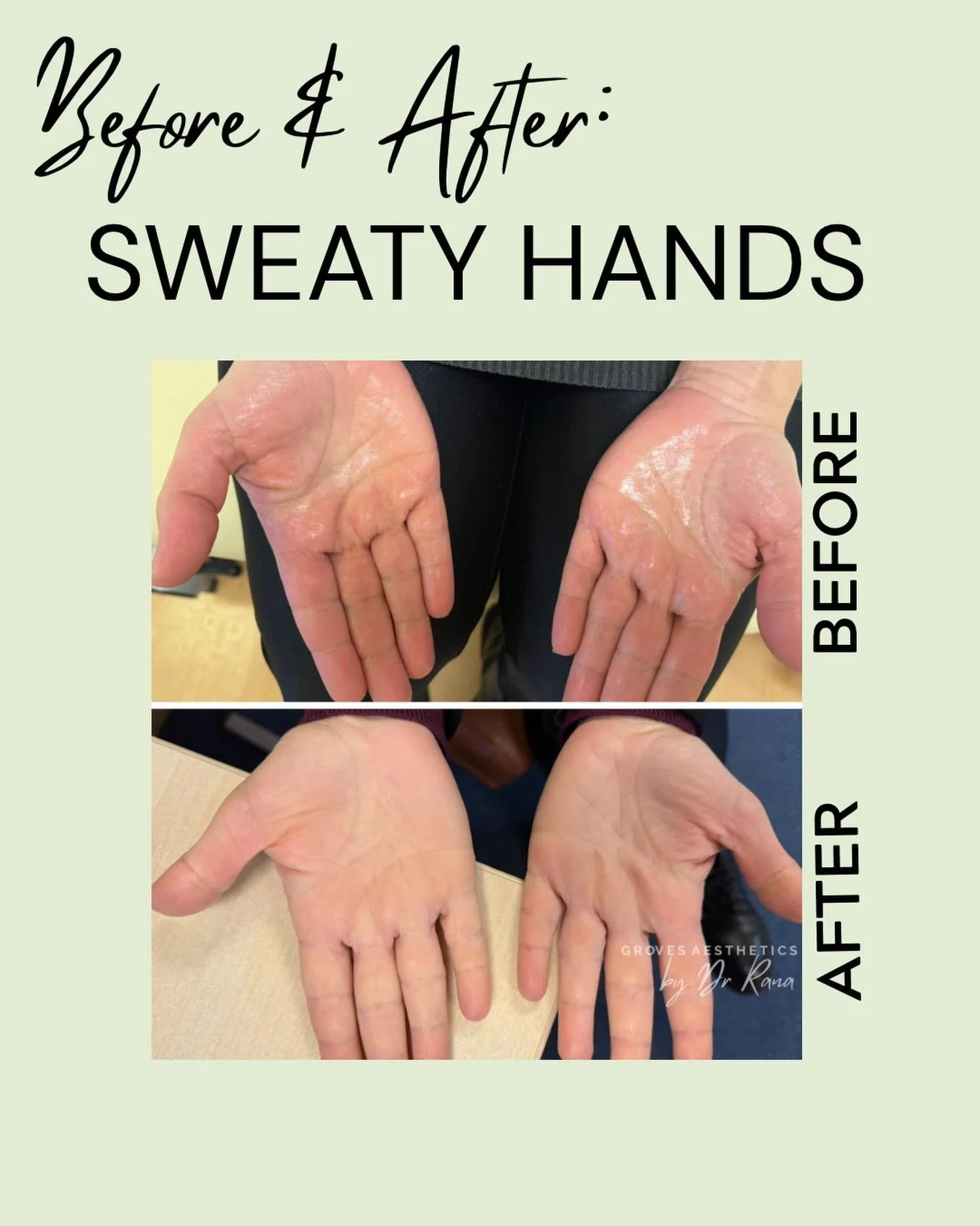 We don&rsquo;t just treat faces 🙌

Excessively sweaty hands, also known as palmar hyperhidrosis, are a common condition affecting up to 3% of the population. It can be triggered by emotional stress, anxiety, genetic factors, or underlying medical co