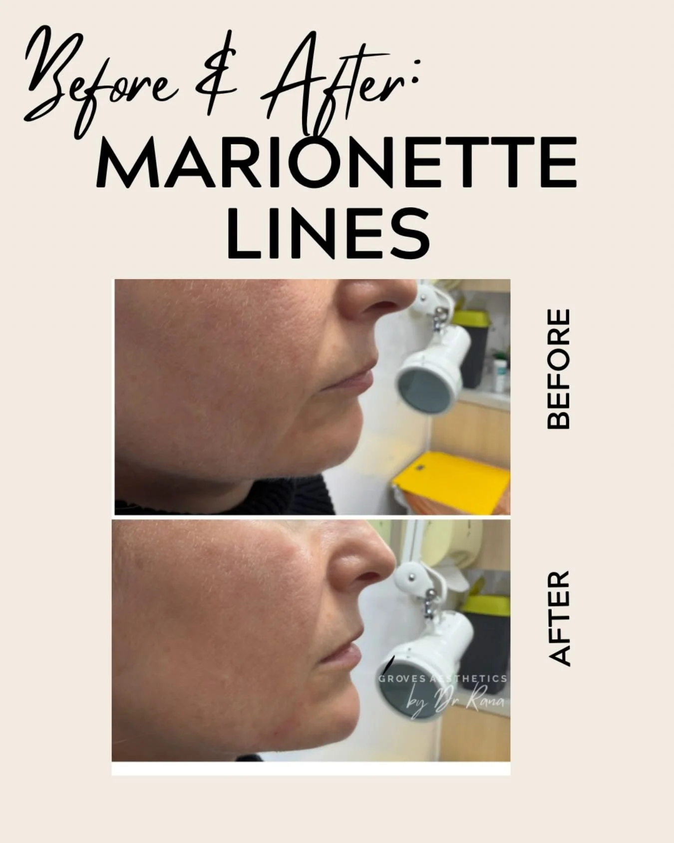 Marionette lines are the vertical lines extending from the corners of the mouth down to the chin. 

They are proof of every smile - but a little self-care never hurts.

Dermal fillers are one of the most effective non surgical way to soften marionett