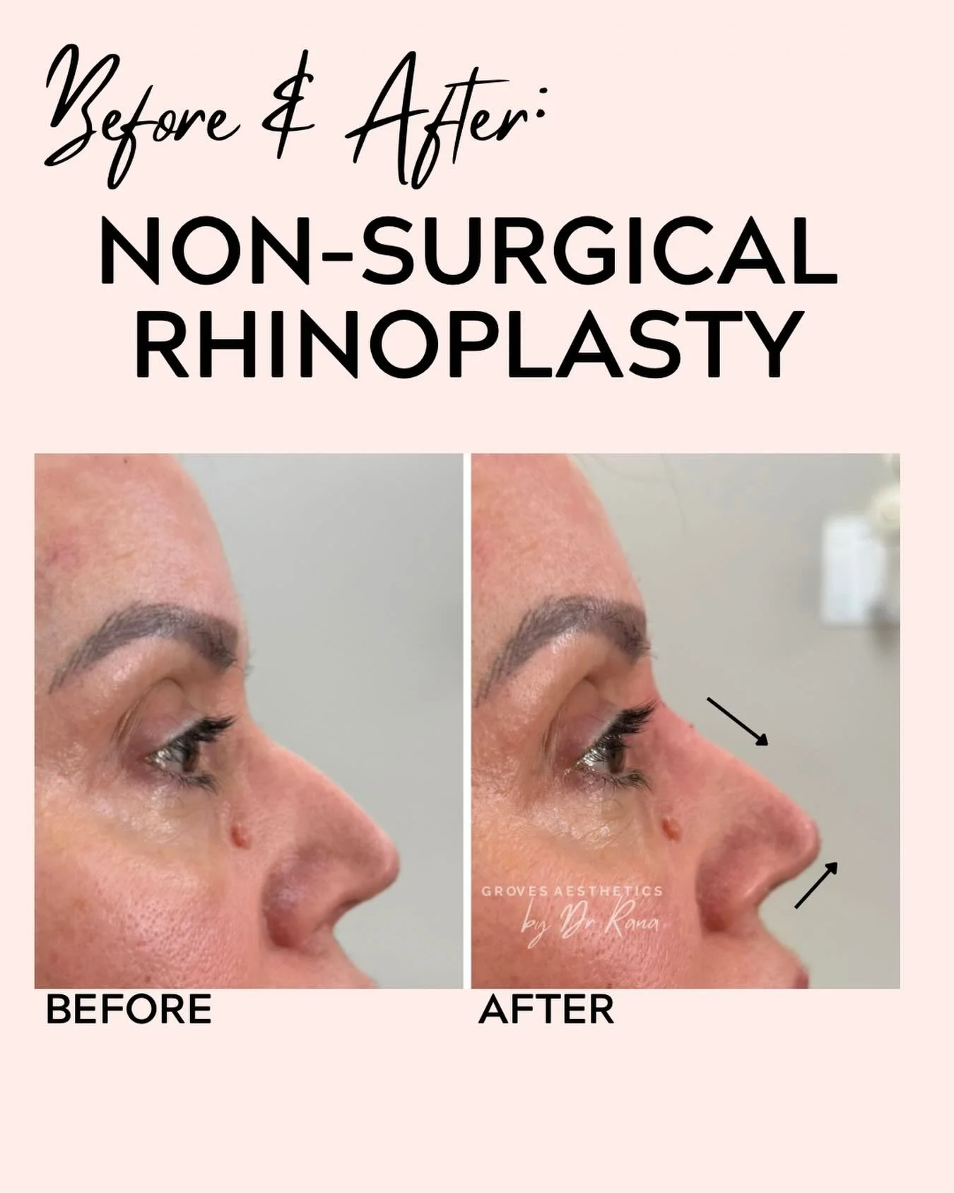 A little can do a lot 💫

Minimal amount of dermal filler used to straighten the angle of the nose for a very natural enhancement 

#nonsurgicalrhinoplasty #DrRana #NewMalden #horsley #facialprofiling