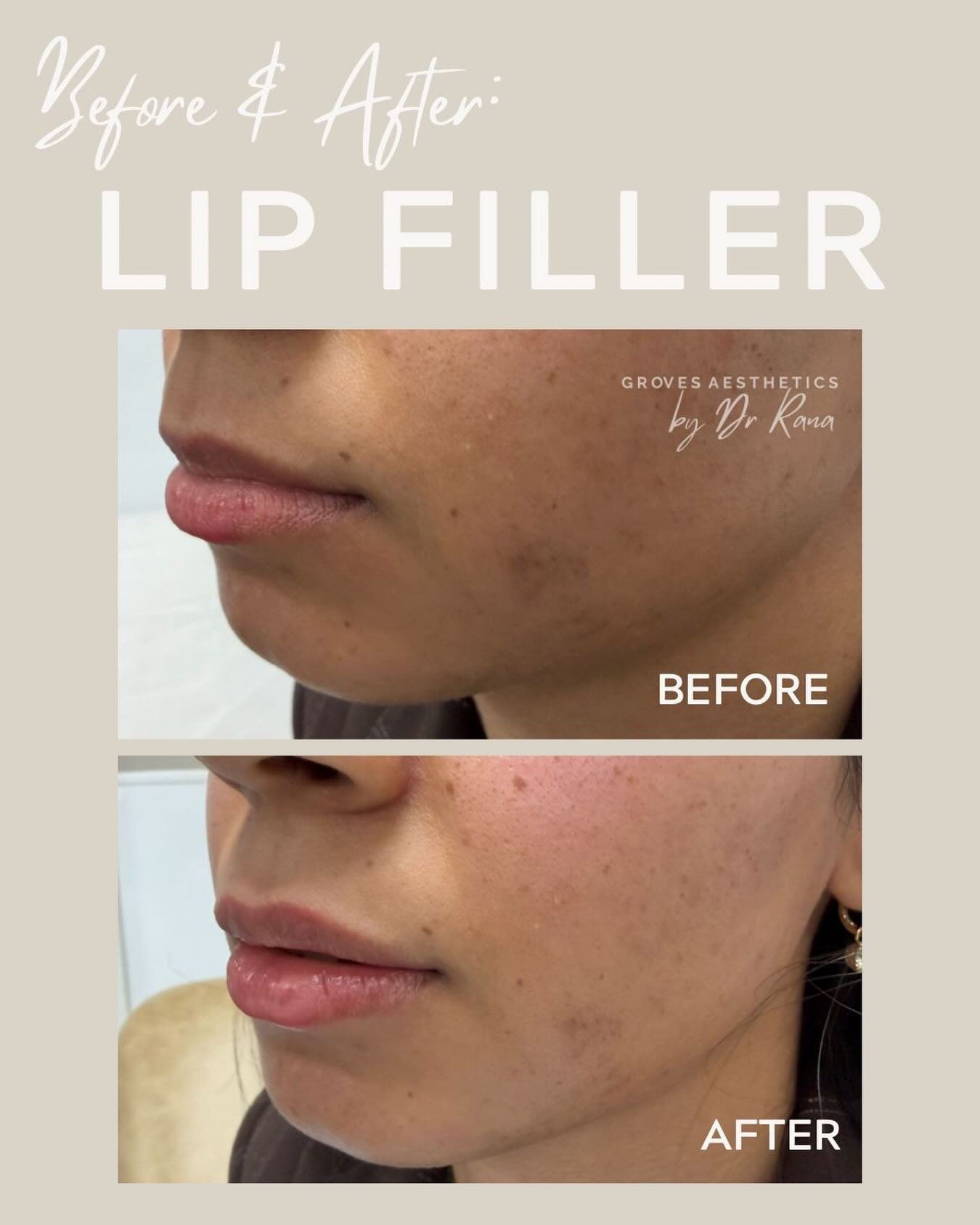 We&rsquo;ve been busier than ever since the Easter break - and still committed to adding a personal touch to every patient journey💫

Just a touch - because subtle hits different 🌿

#lipfillers #subtleenhancement #newmalden #horsley #drrana