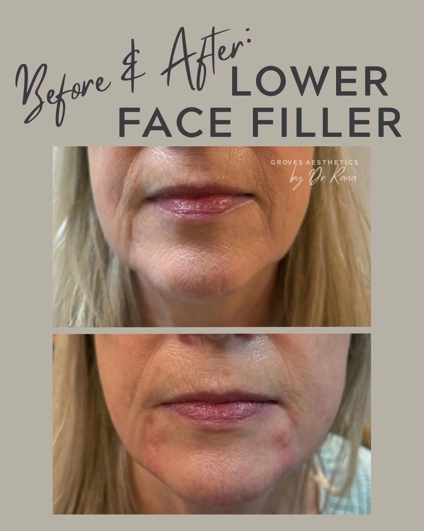 Marrionette lines can be one of the trickiest areas to treat - and not many people talk about that.

Skin laxity, volume loss and muscle movement all play a part. 

This patient had as little as 1ml of HA based dermal filler distributed in the lower 