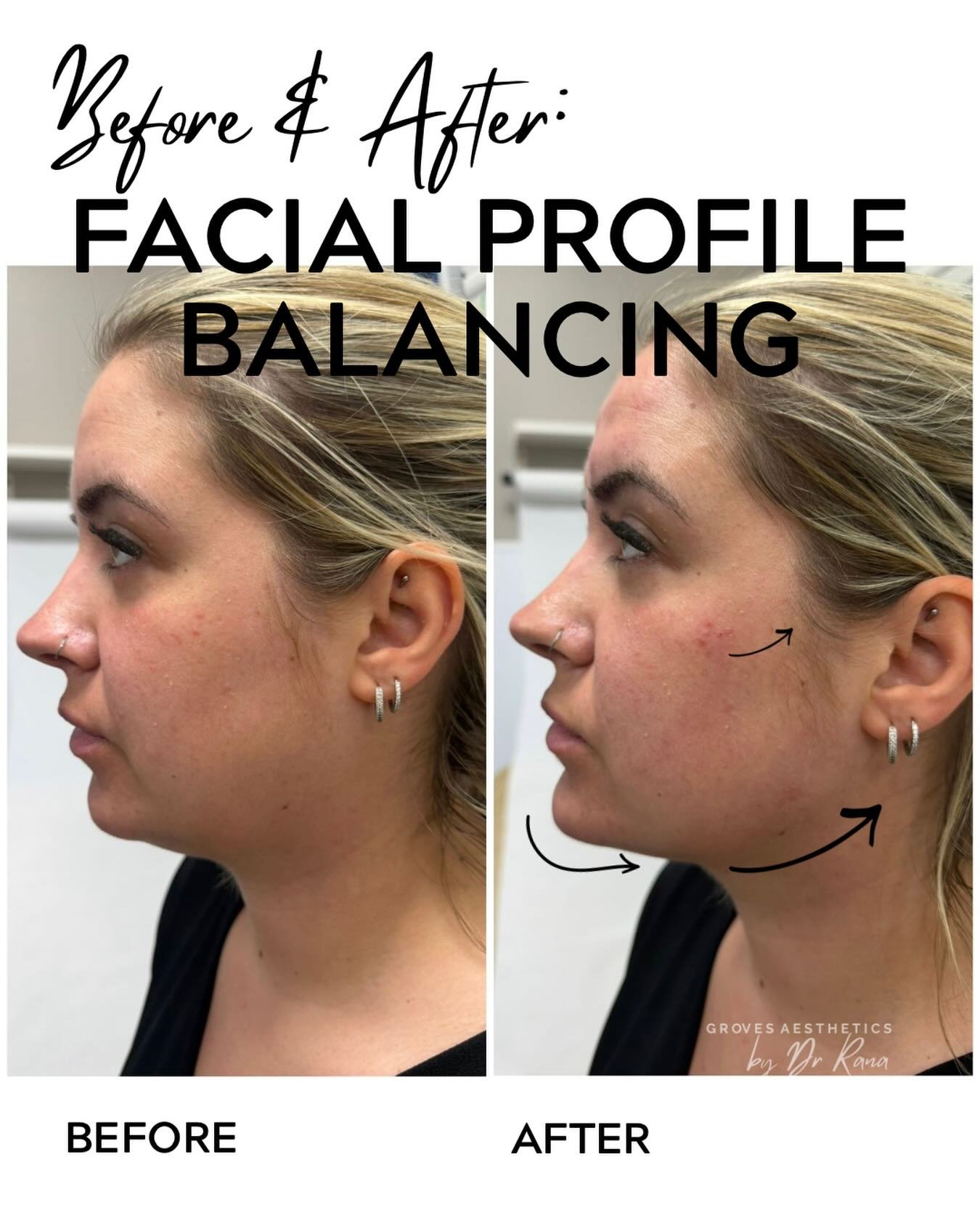 Facial profiling doesn&rsquo;t always have to mean a large volume of dermal filler.

Volumes as little as 1 - 2mls can have a big impact like for this patient 💫

Book today or enquire today by DM 📩✨

#facialprofhiling #newmalden #horsley #dermalfil