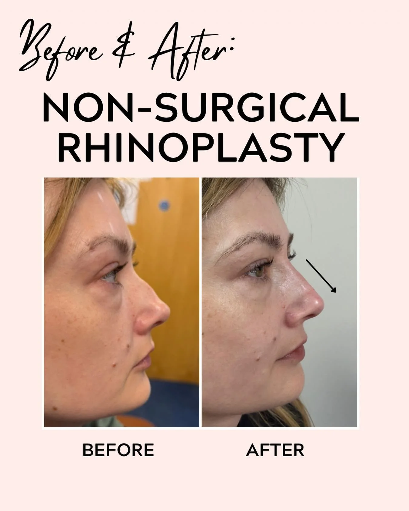 Strategic filler placement can create a smoother, more balanced nose profile with immediate results and minimal downtime - we are so thrilled with the results
